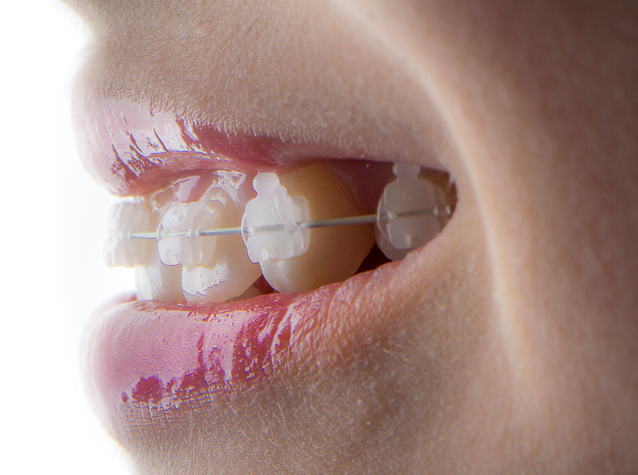 Porcelain Ceramic Braces Santa Barbara CA Porcelain Ceramic Braces Santa Barbara CA